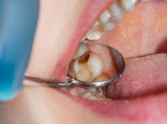 10 советов для снятия зубной боли в домашних условиях