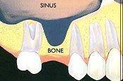 Синус-лифтинг атрофия кости
